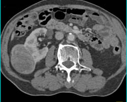 Renal Cell Carcinoma - CTisus CT Scan