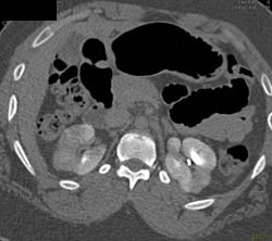 Renal Cell Carcinoma - CTisus CT Scan