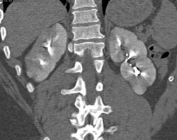 Acute Pyelonephritis - CTisus CT Scan