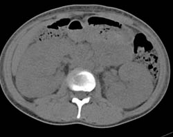 Lymphoma Involves the Kidneys - CTisus CT Scan