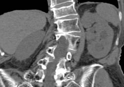 Transitional Cell Carcinoma of the Left Kidney - CTisus CT Scan