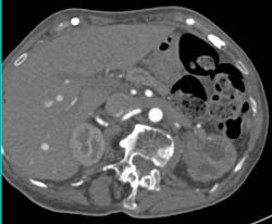 Transitional Cell Carcinoma of the Left Kidney - CTisus CT Scan