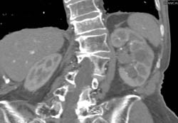 Transitional Cell Carcinoma of the Left Kidney - CTisus CT Scan