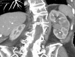 Transitional Cell Carcinoma of the Left Kidney - CTisus CT Scan