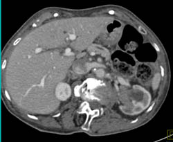 Transitional Cell Carcinoma of the Left Kidney - CTisus CT Scan