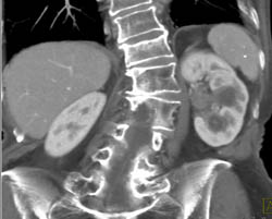 Transitional Cell Carcinoma of the Left Kidney - CTisus CT Scan