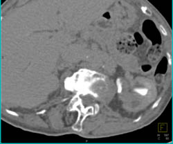 Transitional Cell Carcinoma of the Left Kidney - CTisus CT Scan