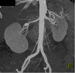 Renal Artery Aneurysm - CTisus CT Scan