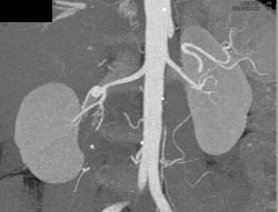 Renal Artery Aneurysm - CTisus CT Scan