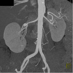 Renal Artery Aneurysm - CTisus CT Scan