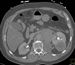 Lymphoma Kidney With Nodes and Bony Involvement - CTisus CT Scan