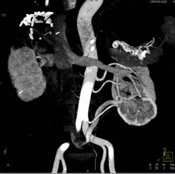 Multiple Left Renal Arteries and Veins - CTisus CT Scan