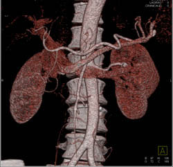 Small Left Renal Artery Aneurysm - CTisus CT Scan