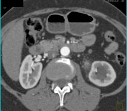 Transitional Cell Cancer (TCC) of Proximal Left Ureter - CTisus CT Scan