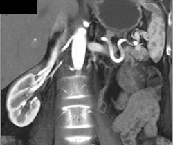 Low Lying Right Kidney - CTisus CT Scan