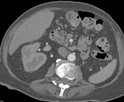 Multiple Renal Cell Carcinomas Right Kidney - CTisus CT Scan