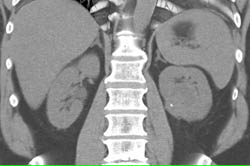 Cystic Renal Cell Carcinoma (RCC) Left Kidney - CTisus CT Scan