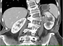 Transitional Cell Cancer (TCC) of Left Kidney- See Full Sequence of Phases - CTisus CT Scan