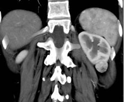 Renal Cell Carcinoma - CTisus CT Scan