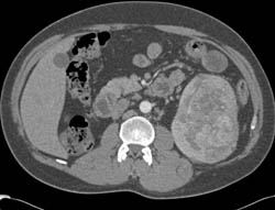 Renal Cell Carcinoma - CTisus CT Scan