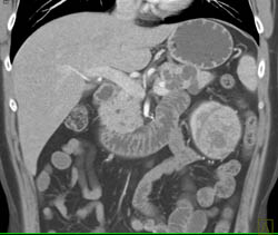 Renal Cell Carcinoma - CTisus CT Scan