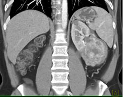 Renal Cell Carcinoma - CTisus CT Scan