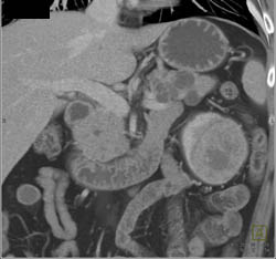 Renal Cell Carcinoma - CTisus CT Scan