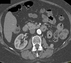 Recurrent Renal Cell Carcinoma in Left Renal Bed - CTisus CT Scan