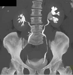 Subtle Transitional Cell Cancer (TCC) of Left Renal Pelvis - CTisus CT Scan