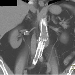 Renal Artery Aneurysm - CTisus CT Scan