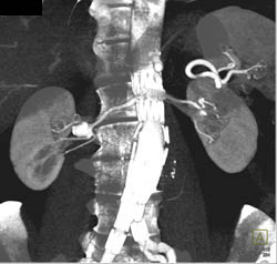 Renal Artery Aneurysm - CTisus CT Scan