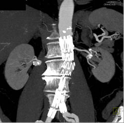 Renal Artery Aneurysm - CTisus CT Scan