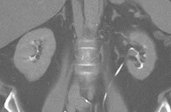 Transitional Cell Cancer (TCC) in Left Renal Pelvis - CTisus CT Scan