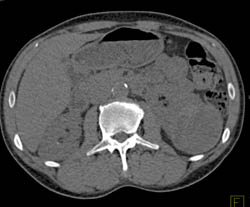 Renal Cell Carcinoma in Left Kidney- Multiple Phases - CTisus CT Scan