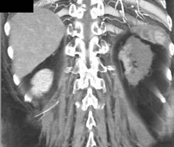 Renal Infarction - CTisus CT Scan