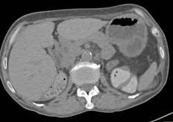 Recurrent Renal Cell Carcinoma (RCC) Involves the Pancreas- See Full Sequence Arterial Phase - CTisus CT Scan