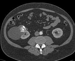 Complex Cyst Without Tumor - CTisus CT Scan