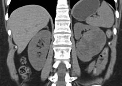 Renal Cell Carcinoma- See Full Sequence - CTisus CT Scan