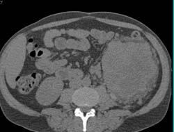 Renal Cell Carcinoma With Renal Vein Extension- See Full Sequence - CTisus CT Scan