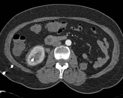 Stone Right Kidney With Left Nephrectomy - CTisus CT Scan