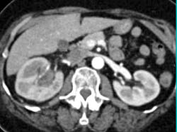 Transitional Cell Cancer (TCC) of Right Kidney Involves the Renal Vein and IVC - CTisus CT Scan