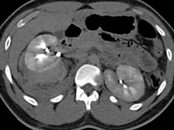 Acute Pyelonephritis With Right Peri-renal Bleed - CTisus CT Scan