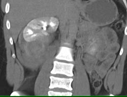 Perirenal Hematoma With Bleed- See Full Sequence. S/P Renal Laceration - CTisus CT Scan