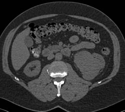 Renal Cell Carcinoma Simulates A Transitional Cell Cancer (TCC) - CTisus CT Scan