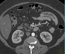 Renal Cell Carcinoma - CTisus CT Scan