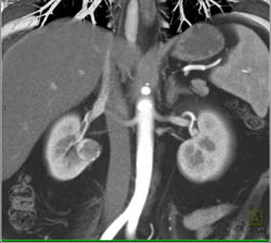 Renal Cell Carcinoma - CTisus CT Scan