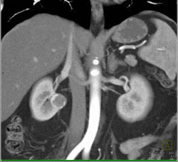 Renal Cell Carcinoma - CTisus CT Scan