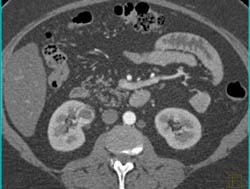 Renal Cell Carcinoma - CTisus CT Scan