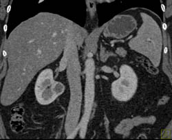 Renal Cell Carcinoma - CTisus CT Scan