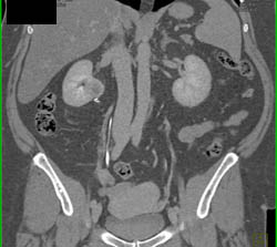 Renal Cell Carcinoma - CTisus CT Scan